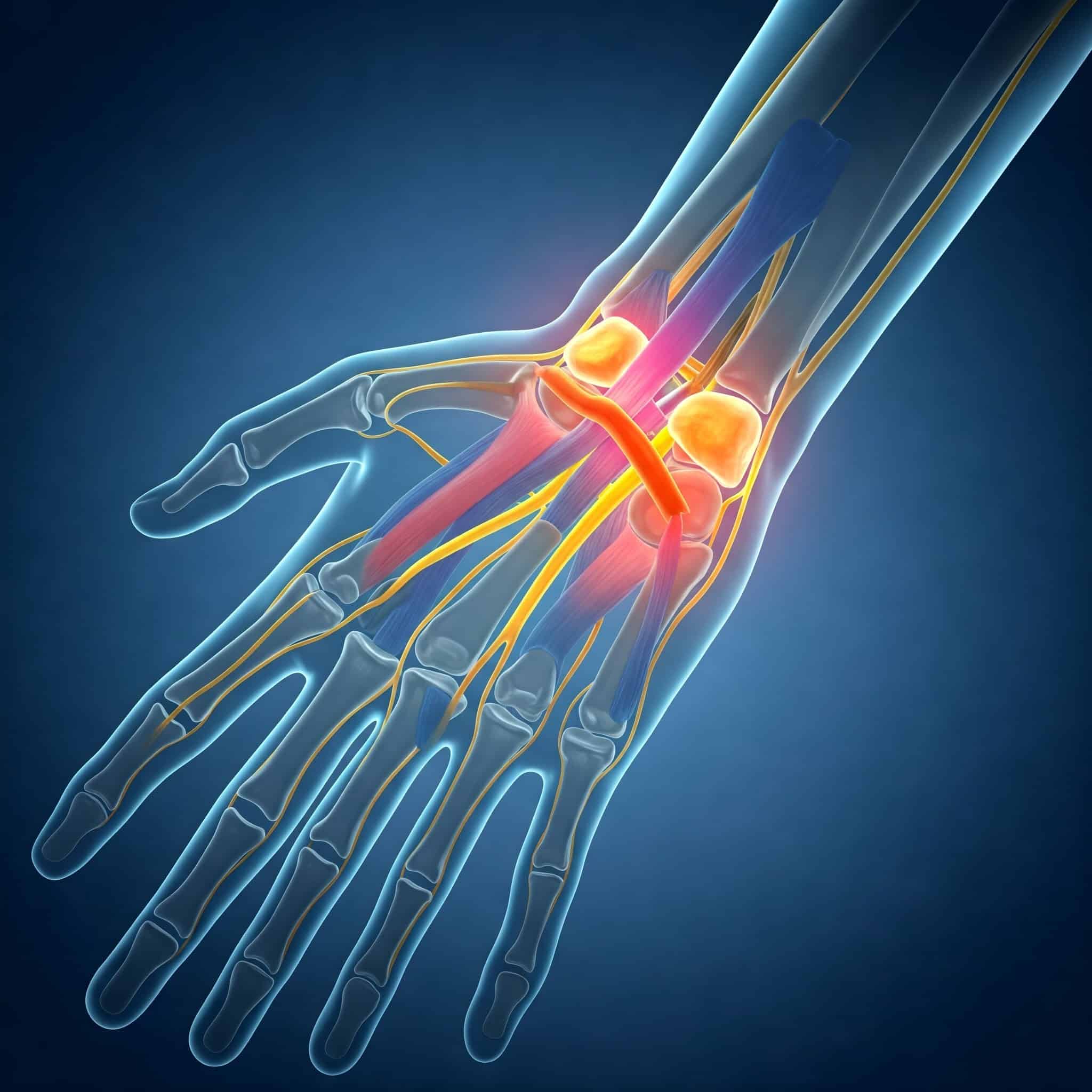 Sinir Sıkışmaları