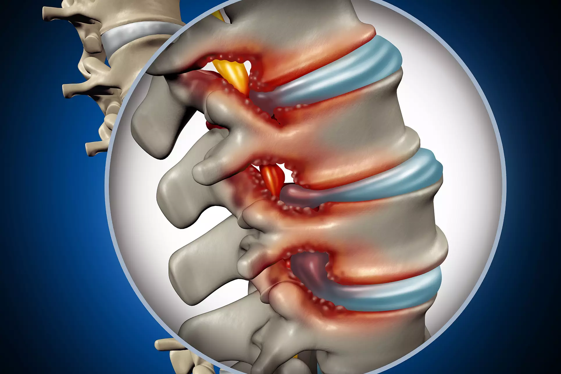 Belde Kanal Daralması